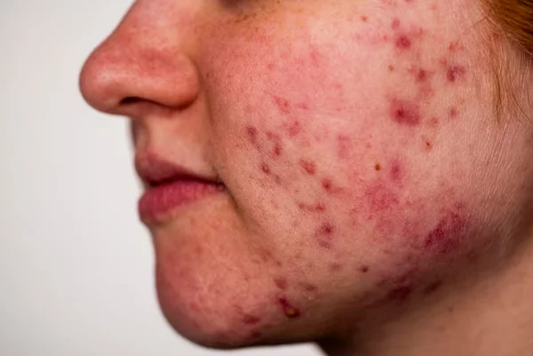 Acne Treatment