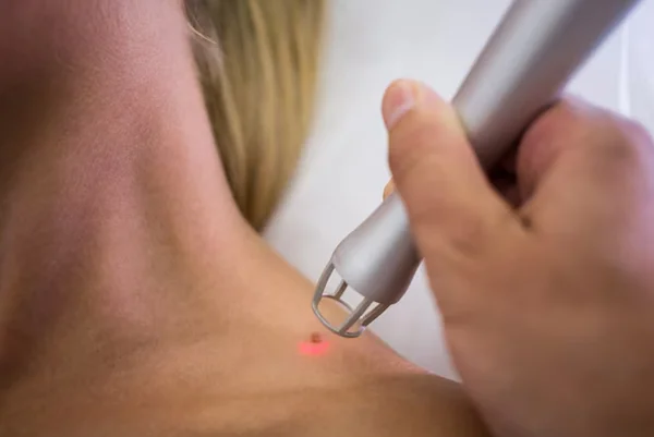 Wart Removal