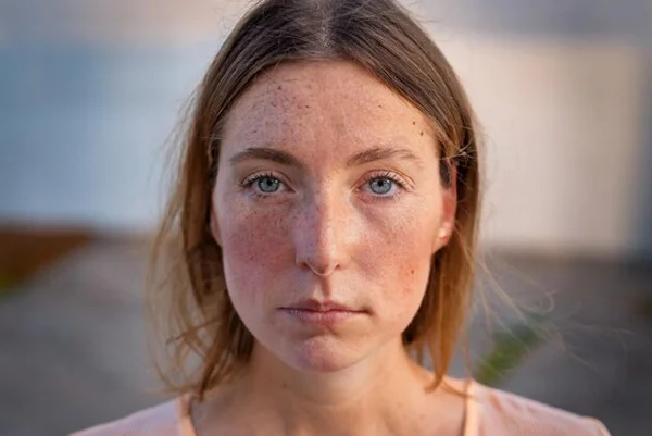 Sun Spots or Age Spots and Pigmented Lesions