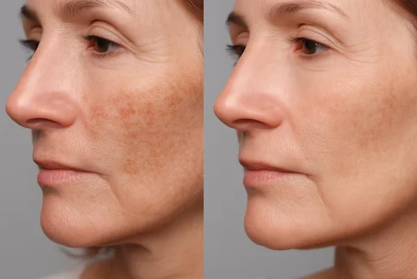Melasma Treatment