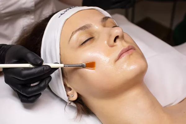 Chemical Peel