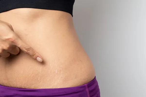 Stretch Marks Treatment